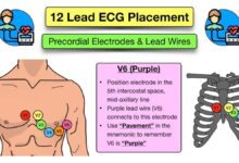 leads on ecg